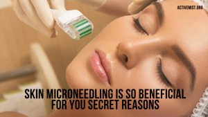 Skin Microneedling Is So Beneficial for You (Secret Reasons)