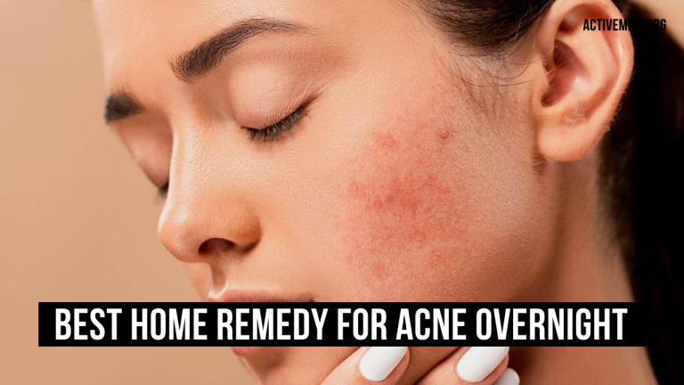 Best Home Remedy For Acne Overnight: (6 Remedies)